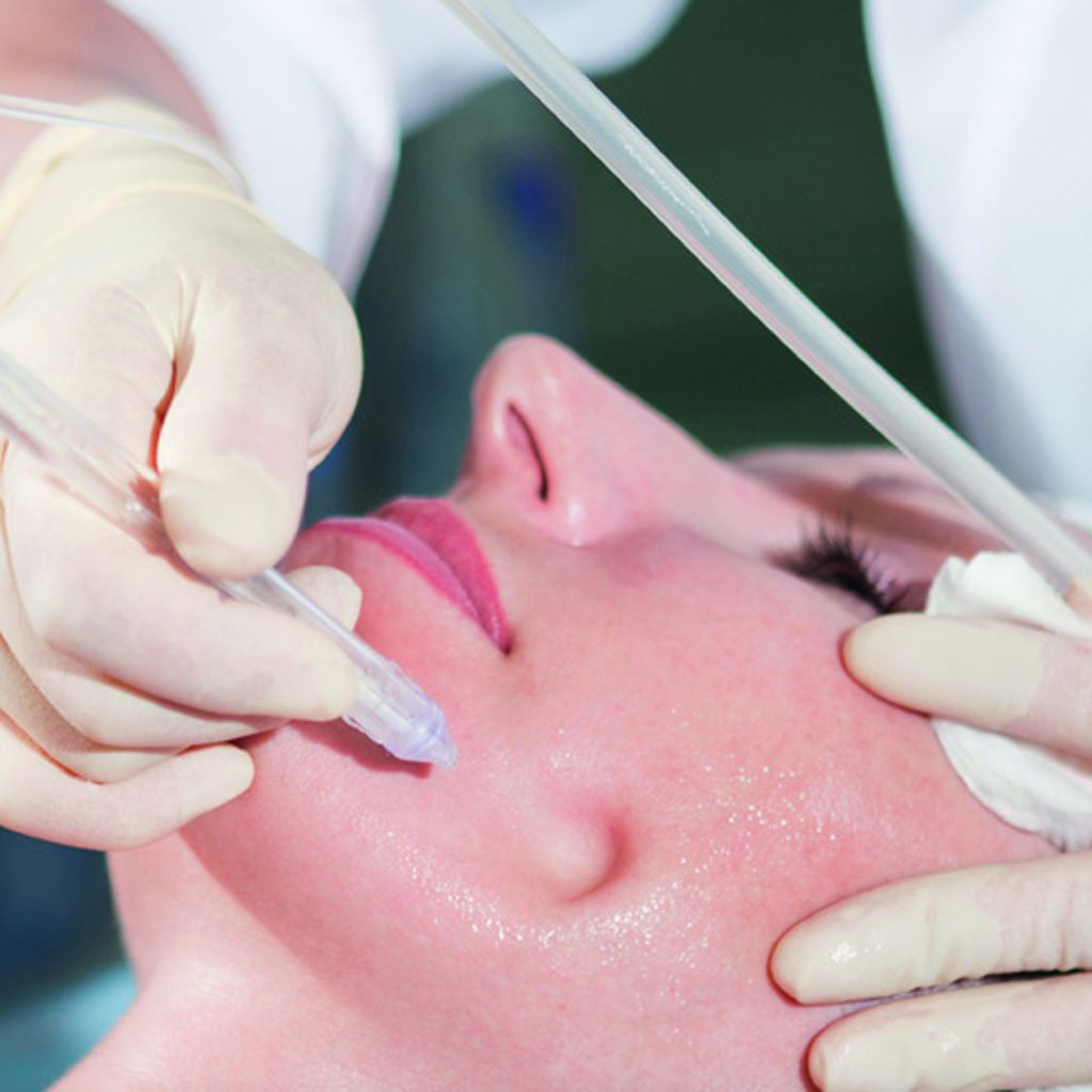 JetPeel Gesichtsbehandlung im Studio IMMERSCHÖN in Stuttgart Vaihingen